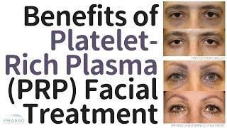 Benefits of Platelet-Rich Plasma (PRP) Facial Treatment, and Why the Vampire Facelift® is Different