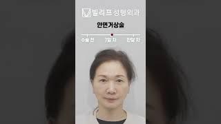 안면거상술 한달 차 전후 비교