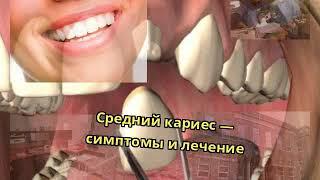 Средний кариес — симптомы и лечение