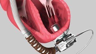 Medical Device Animation 2018 AXS Showreel