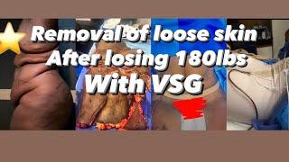 SKIN REMOVAL SURGEY AFTER LOSING 180  POUNDS WITH GASTRIC SLEEVE IN 2 YEARS.