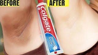 In Just 5 minutes, HOW TO LIGHTEN DARK UNDERARM NATURALLY AND FAST AT HOME | 100% PERMANENT RESULTS