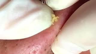 Blackheads Removal Great Face Skin Care for Customers #6