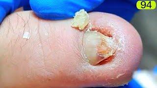 94-Ingrown.  great process