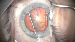 phacotrabectome in narrow angle, low pressure glaucoma and floppy iris #2