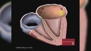 The Mayo Clinic explains how to treat Atrial Fibrillation