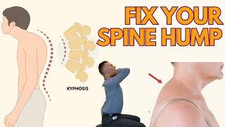 Back Hump Exercises and Posture Fix | KyphosisTreatment Toronto