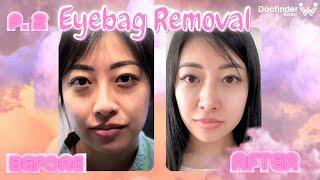 Docfinderkorea manager gets plastic surgery! Part 2