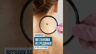 Меланома из родинки возникает в 70% случаев!