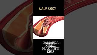 Kalp krizi nasıl olur?, Tıp Videoları, Prof.Dr.Serdar Akgün