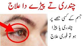 Chandri da ilaj | Guhanjni ka ilaj | Treatment of eye pimple | Ankh ki bimari ka ilaj |peray da ilaj