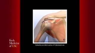 FOX Sports Keck Medicine of USC Report: Treating Rotator Cuff Injuries