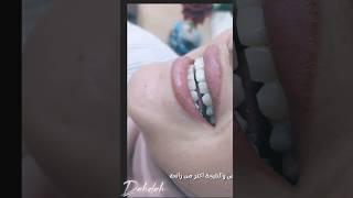 Teeth whitening @DrduaaShokrydahdah-us5zk #dentist #hollywoodsmile #syria #beforeandafter #اكسبلور