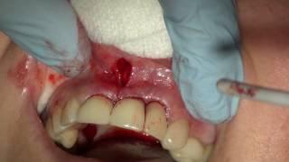 Correcting bony and tissue defect with synthetic bone graft and soft tissue graft in aesthetic zone.