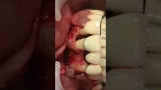 Gingival Flap Surgery