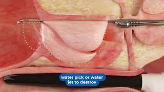Aquablation Tool For Enlarged Prostate - Memorial Healthcare System
