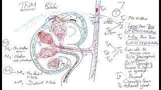 Easy way to remember TNM Staging of Renal Cell Carcinoma with Visual mnemonic