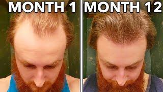How To Reverse Hair Loss In 12 Months