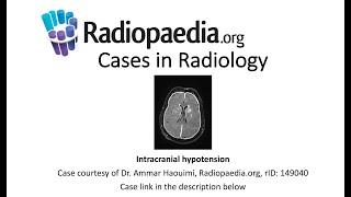 Intracranial hypotension (Radiopaedia.org) Cases in Radiology