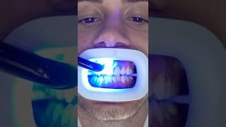 Transformation of Yellow Teeth! #teethwhitening