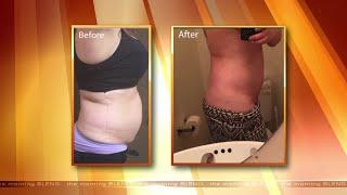 Non-Surgical Body Contouring That Will Help You Lose Weight In Las Vegas