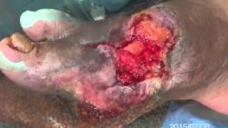 Diabetic foot healing