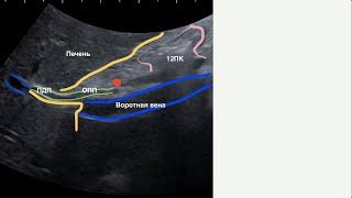 Ультразвуковая диагностика желчных протоков