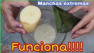 COMO QUITAR MANCHAS DE TU CARA EXTREMAS/ REMEDIO CASERO PARA MANCHAS