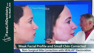 Weak Facial Profile and Small Chin Corrected, No Jaw Surgery