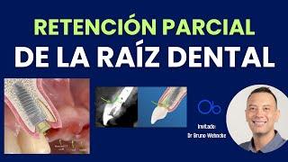 Retención parcial de la raíz dental  con Dr Bruno Wehncke