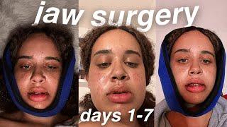 first week of jaw surgery recovery: i feel more dead than alive... (days 1-7)