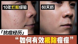 How to treat acne and acne scar? Niacinamide saves my face!