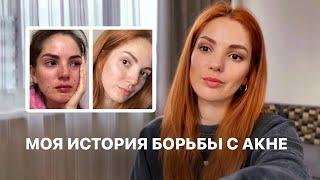 КАК Я ВЫЛЕЧИЛА ПРЫЩИ?! МОЯ ИСТОРИЯ С АКНЕ. МОЙ УХОД ЗА КОЖЕЙ