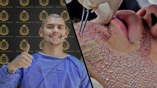 Marcos GARCIA Hair Transplant, Beard Transplant - (Transplante Capılar) - #transplantecapilar