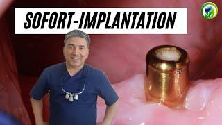 Sofortimplantation Patientenfall - Erhalt des Zahnersatzes möglich, Zahnimplantat , Implantation
