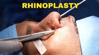 Nose Job Surgery (Closed Rhinoplasty Surgery) | Procedure | Rhinoplasty in India