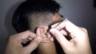 Removing A Bubble Gum Stuck in Man's Ear - This is Insane!