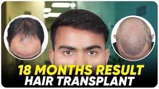 Hair Transplant in Agra | Best Results & Cost of Hair Transplant in Agra