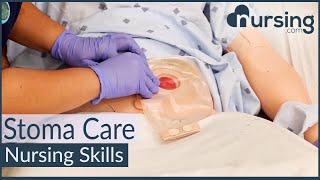 Stoma Care- Changing a Colostomy Bag (Nursing Skills)