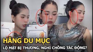 Hằng Du Muc lộ mặt bị thương, nghi chồng tác động?