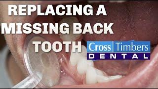 Case of the Week: Replacing a missing back tooth