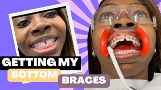 Witness My Life Changing Braces Journey | #adultbraces | Just Wideline