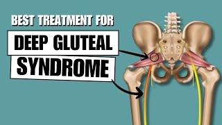 The BEST Deep Gluteal Syndrome Treatment (Science-based)