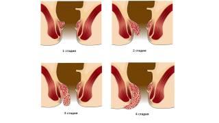 Геморрой - лечение быстро и без боли!