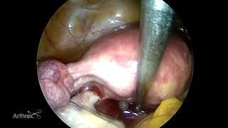 SynergyUHD4™ Laparoscopic Tubal Ligation