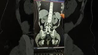 kidney stone in CT scan.  #ct #kidney #stone