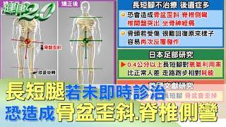 長短腿若未即時診治 恐造成骨盆歪斜.脊椎側彎 健康2.0