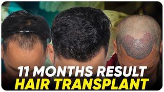 Hair Transplant in Iran | Best Results & Cost of Hair Transplant in Iran