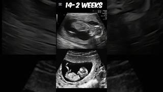 Baby at 14.2 weeks ultrasound | #baby #pregnancy #14weeks