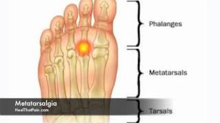 Metatarsalgia Foot Pain Causes, Symptoms, & Treatments